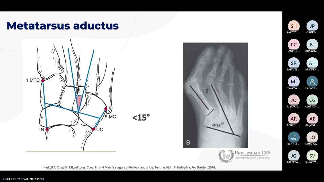 HALLUX VALGUS (*JUANETE): causas, síntomas y opciones de tratamiento explicadas
