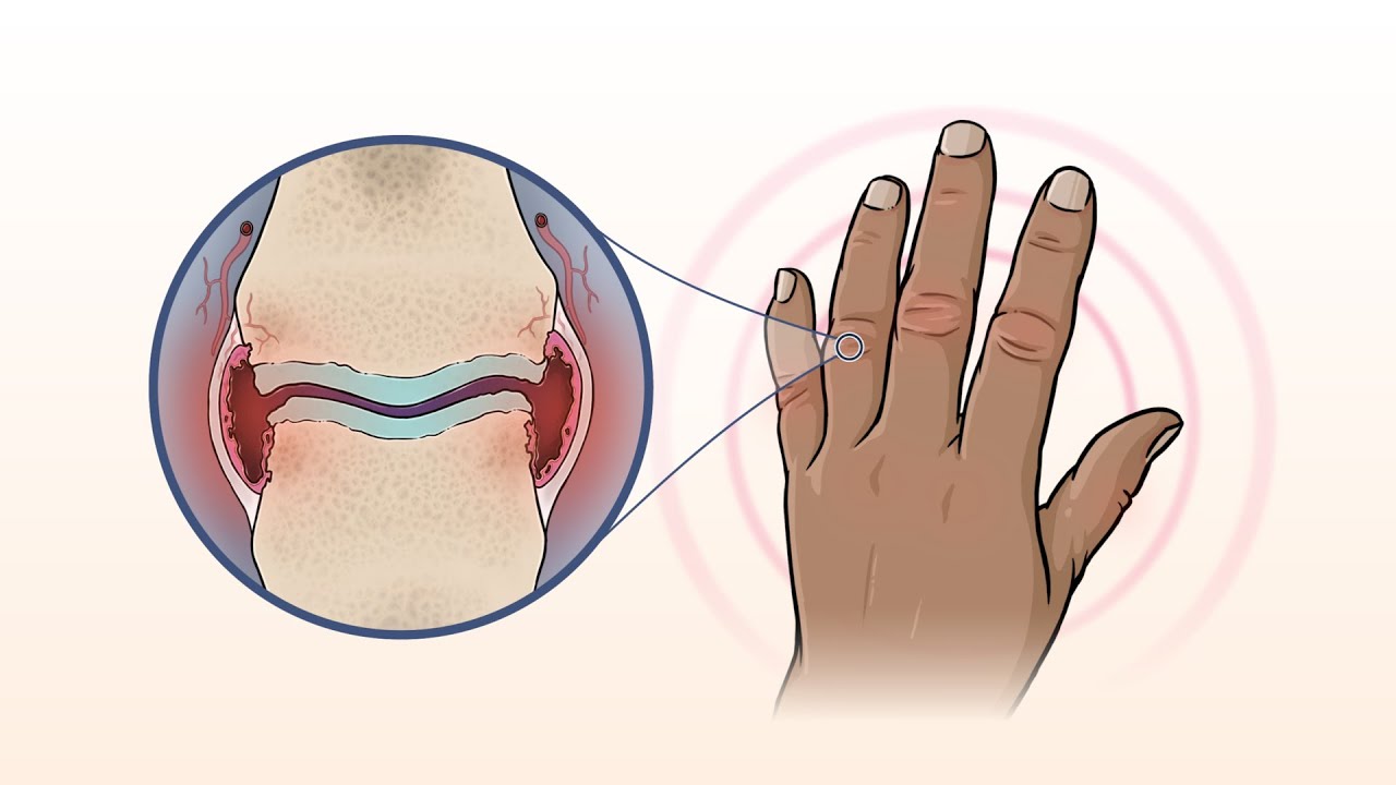 What Is Rheumatoid Arthritis? | NEJM