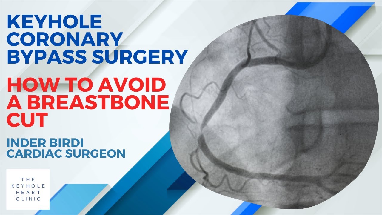 What You Need To Know About Keyhole Coronary Bypass Surgery