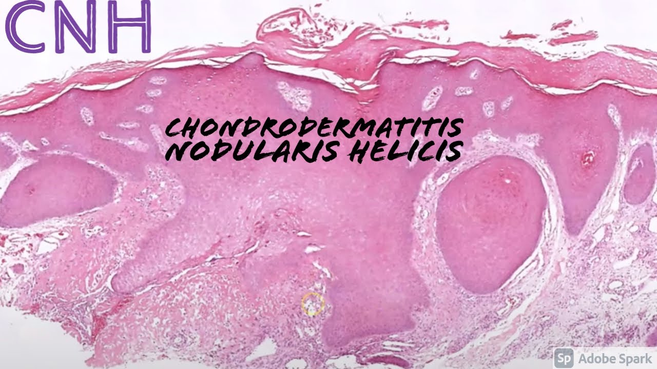 Chondrodermatitis Nodularis Helicis (CNH): 5-Minute Pathology Pearls