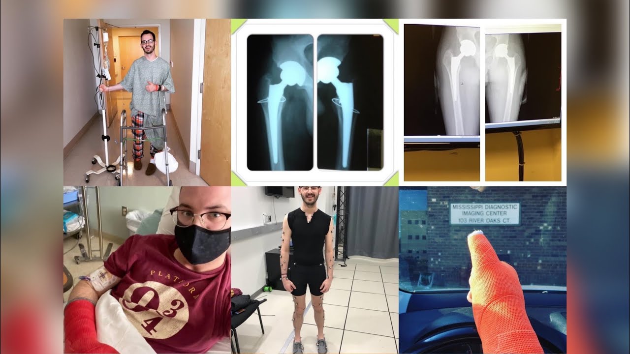 My journey to diagnosis of an ultra-rare genetic bone disease called Hypophosphatasia