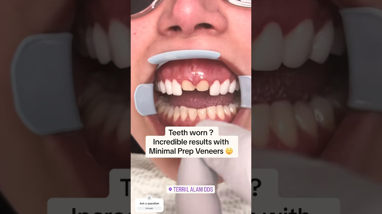Porcelain veneers for worn down teeth. Simply amazing ❤️