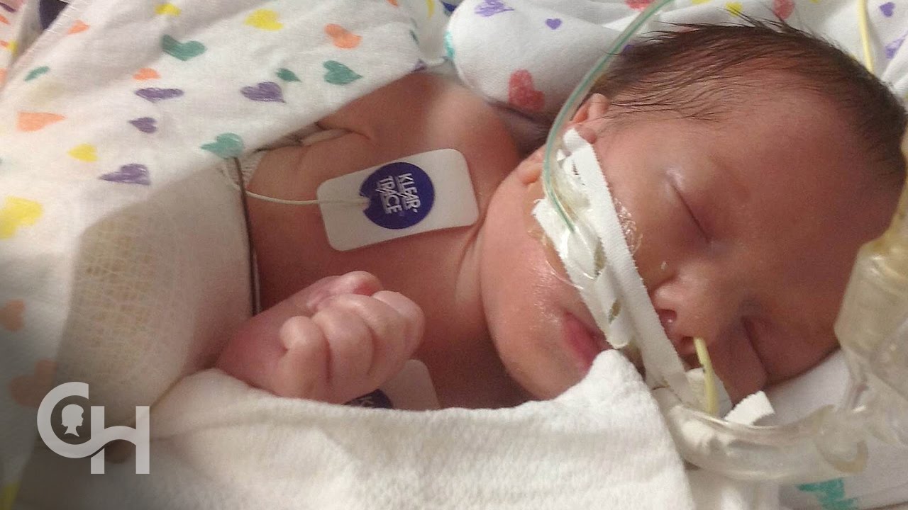 Jameson’s Omphalocele Story: Look at Him Now