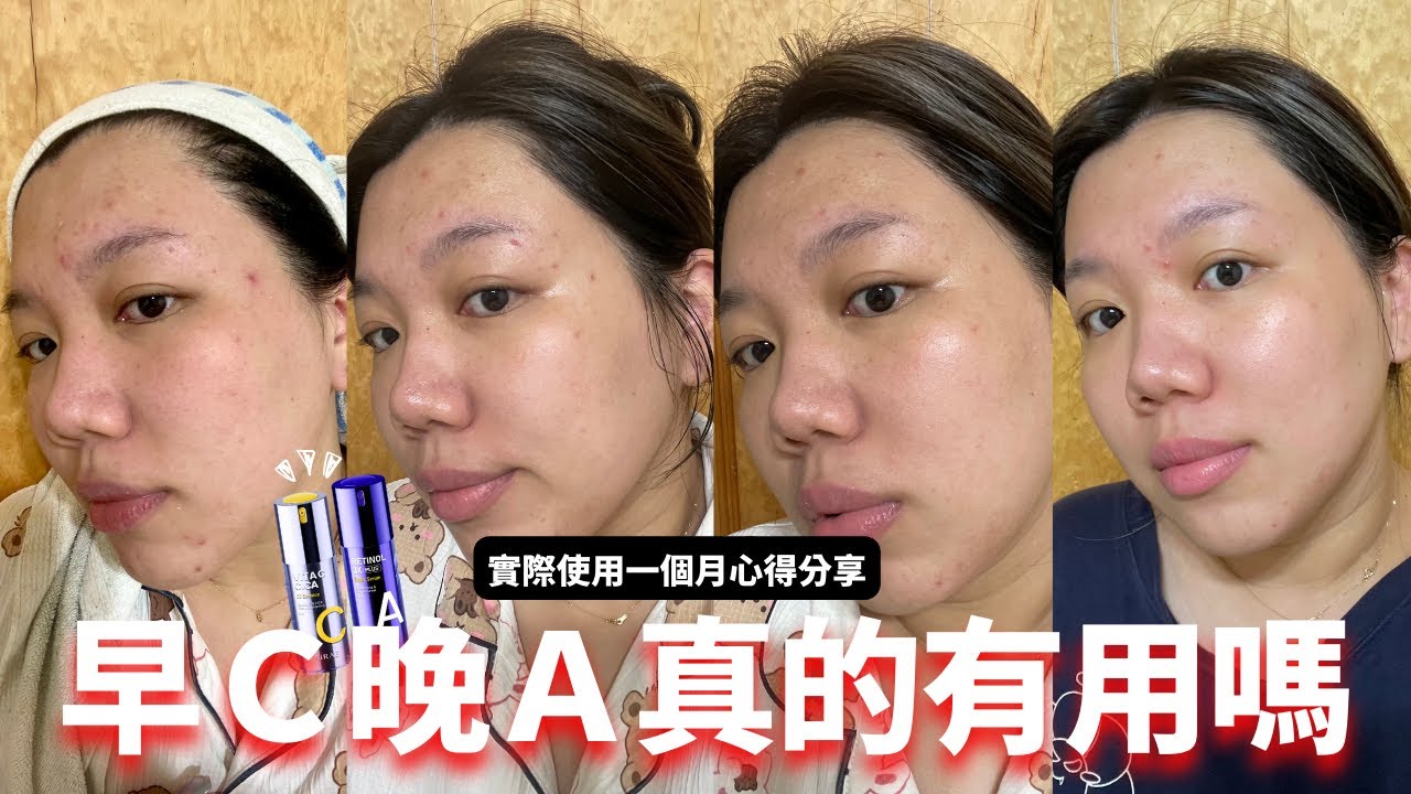 皮膚一直長痘痘！早C晚A保養真的有用？(未來美實測一個月)