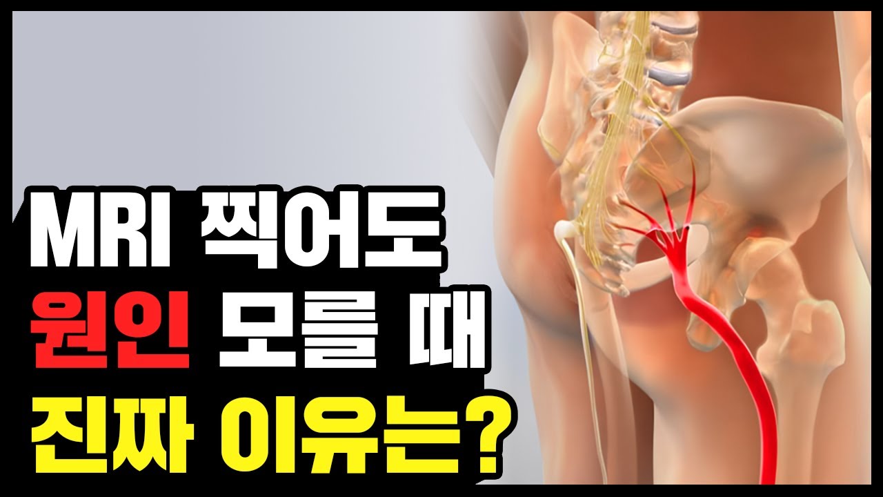 MRI 정상이지만 다리가 저린 이유 | 좌골신경통 vs 기능적 문제