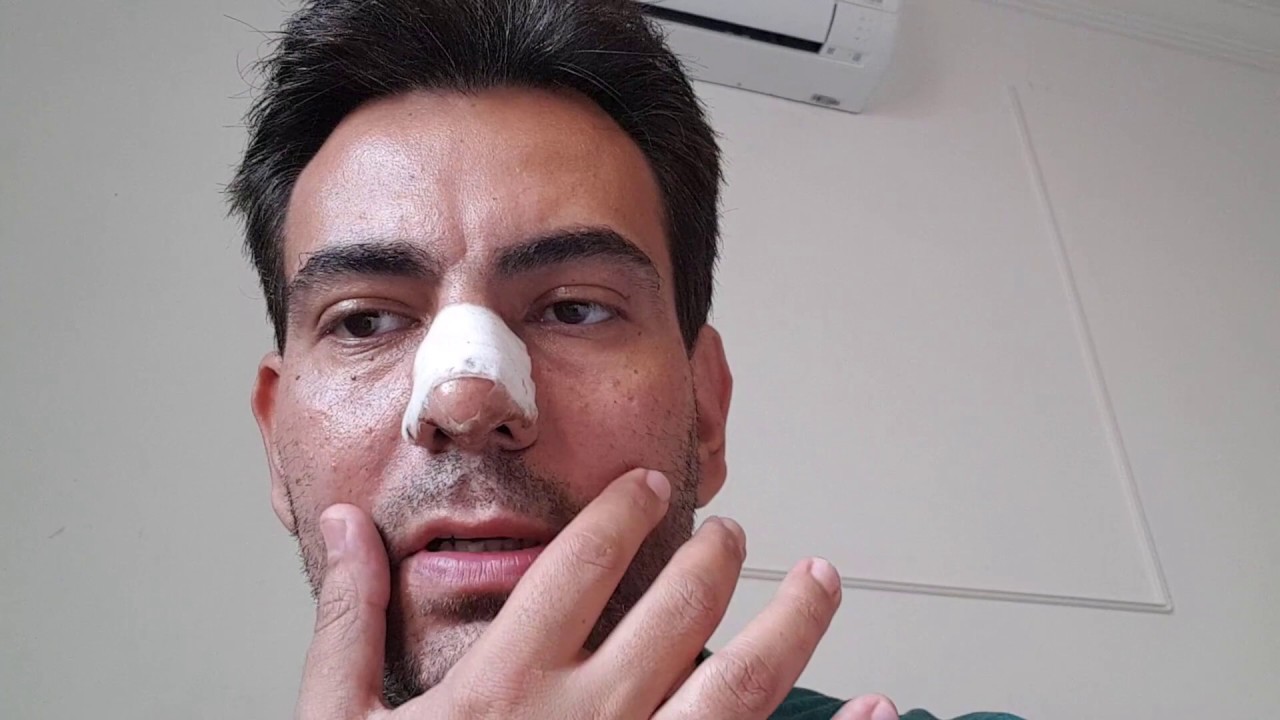 Relato de Cirurgia de Correção de Desvio de Septo | Rinoplastia e Septoplastia