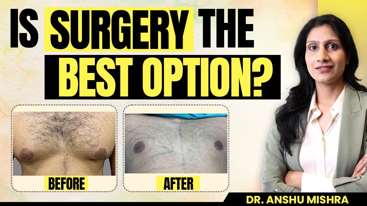 Gynecomastia Surgery: All You Need to Know | Recovery, Side Effects, Results | Dr Anshu Mishra Dubai