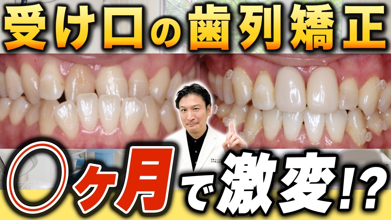 症例紹介！〜受け口編〜【歯列矯正を検討中の方必見！】