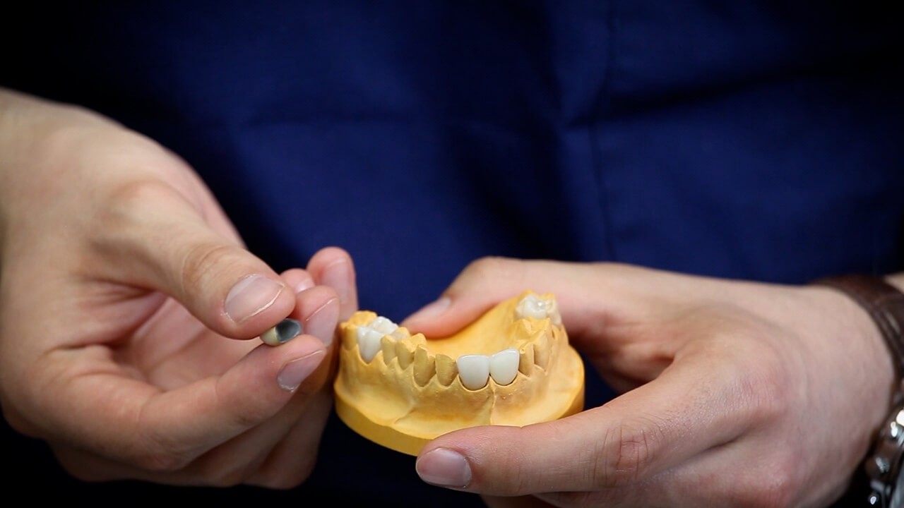 Drei verschiedene Zahnkronen - Sedlmeier Dental
