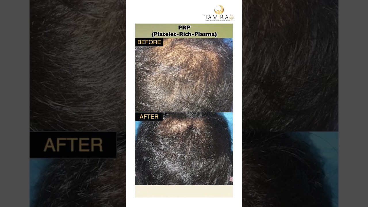 PRP Hair Transformation | Before & After Results You Can Trust