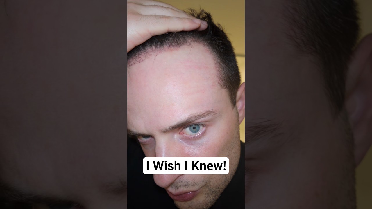 تحديث بعد 3 أشهر من عملية زراعة الشعر (لم أتوقع هذا) @SmileHairClinic