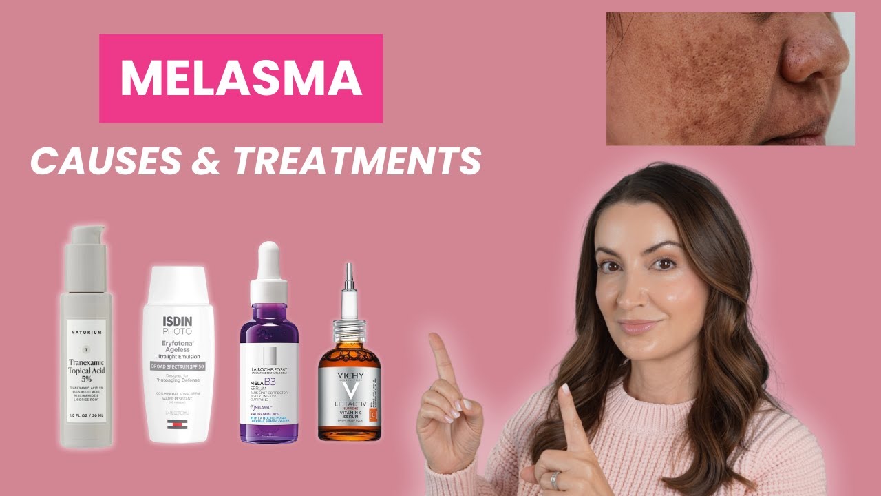Dermatologist's Guide to Melasma: Causes, Prevention & Treatments | Dr. Aleksandra Brown