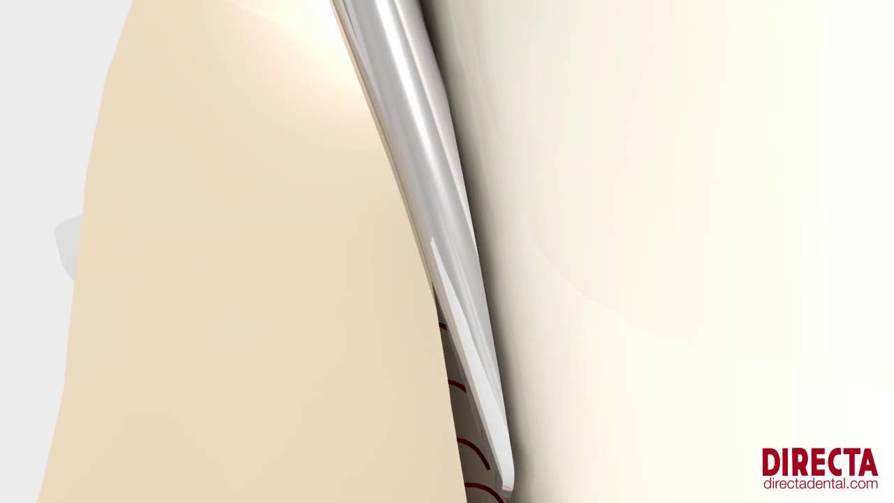 Luxator® Periotome by Directa - dramatically less trauma for your patients