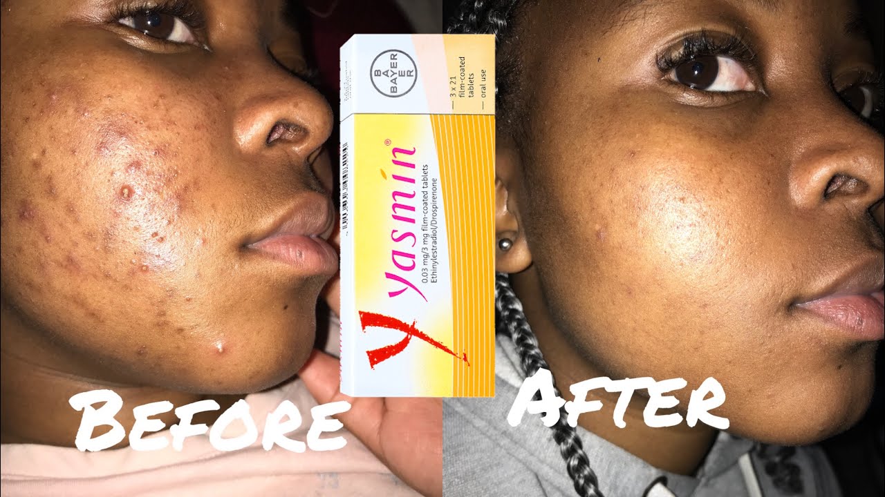 My Acne journey. Contraceptive pills for skin?|| How I cleared my acne || South African YouTuber