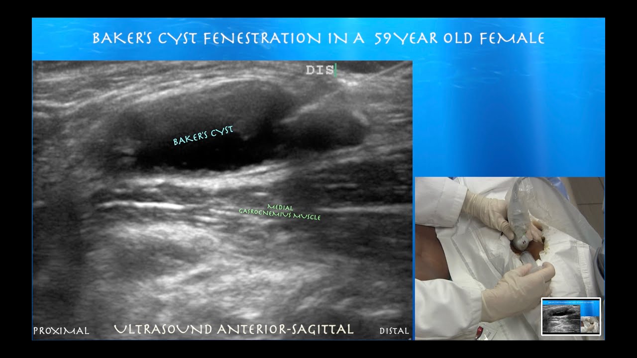 Ultrasound Guided Popliteal Cyst Aspiration & Fenestration
