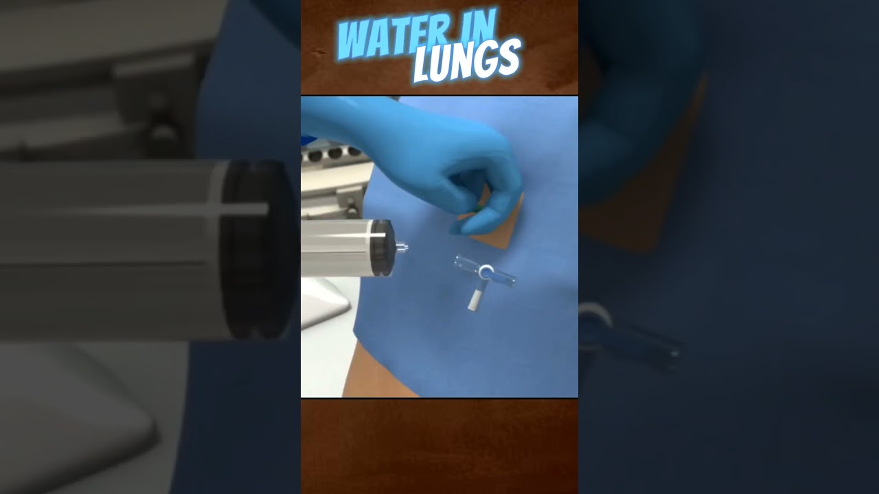 Water in Lungs Treatment | Pleural Fluid Aspiration in 3D