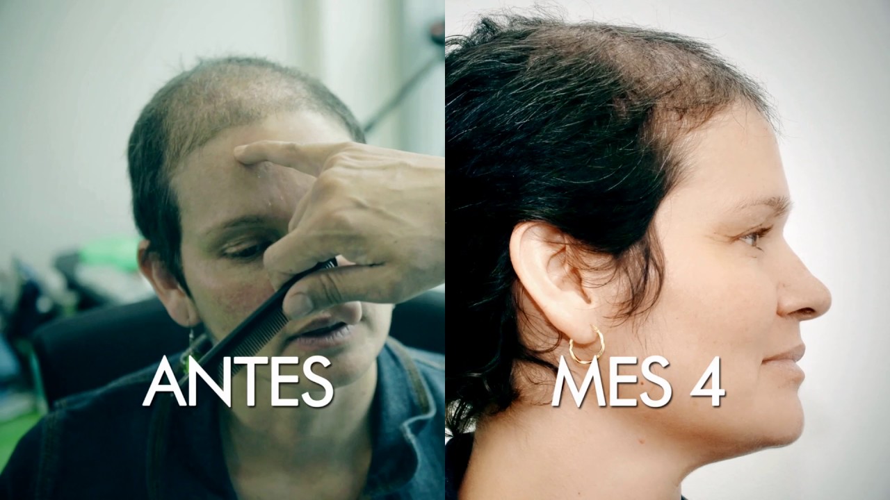 Clara Barahona - Trasplante Capilar en René Rodríguez MD - Capítulo 2