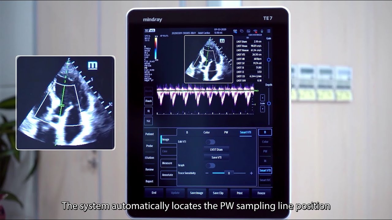 Mindray TE7 ACE- Smart VTI Demo Video
