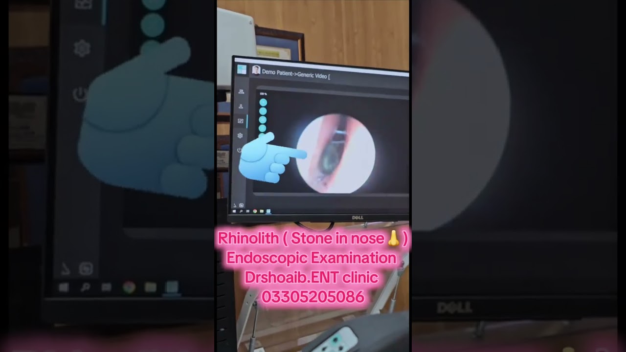 Endoscopic Examination of Rhinolith | Dr Shoaib ENT Clinic