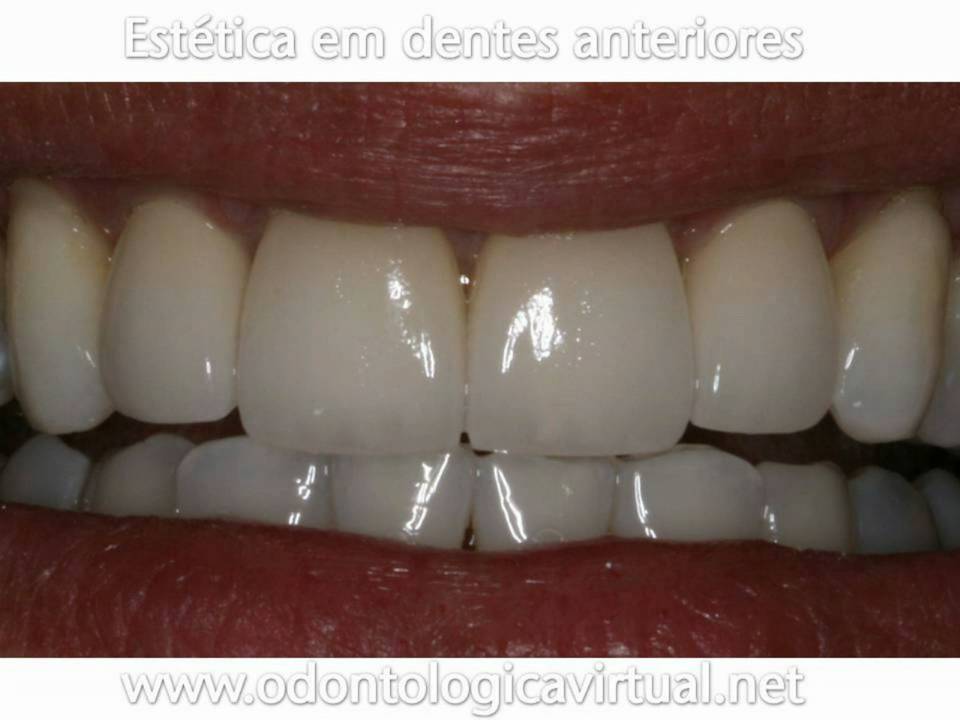 Odontologia Estética em Dentes  Anteriores