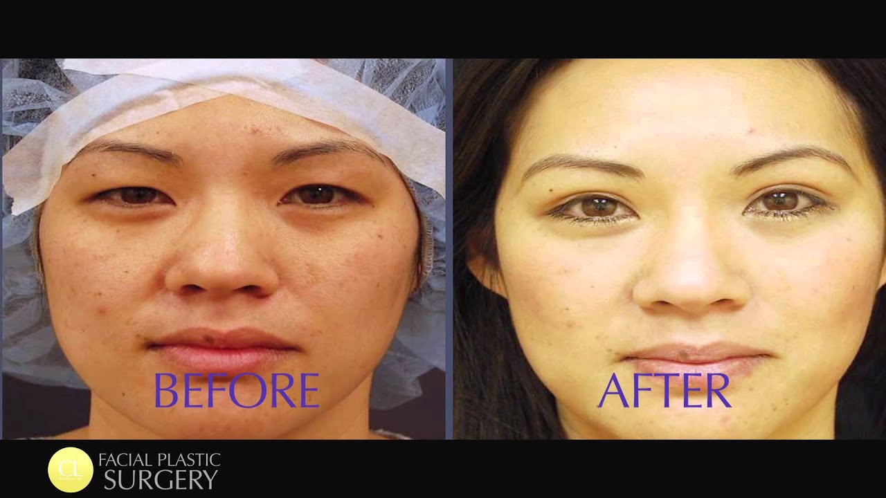 #ChaseLayMD Asian Eyelid Surgery 02