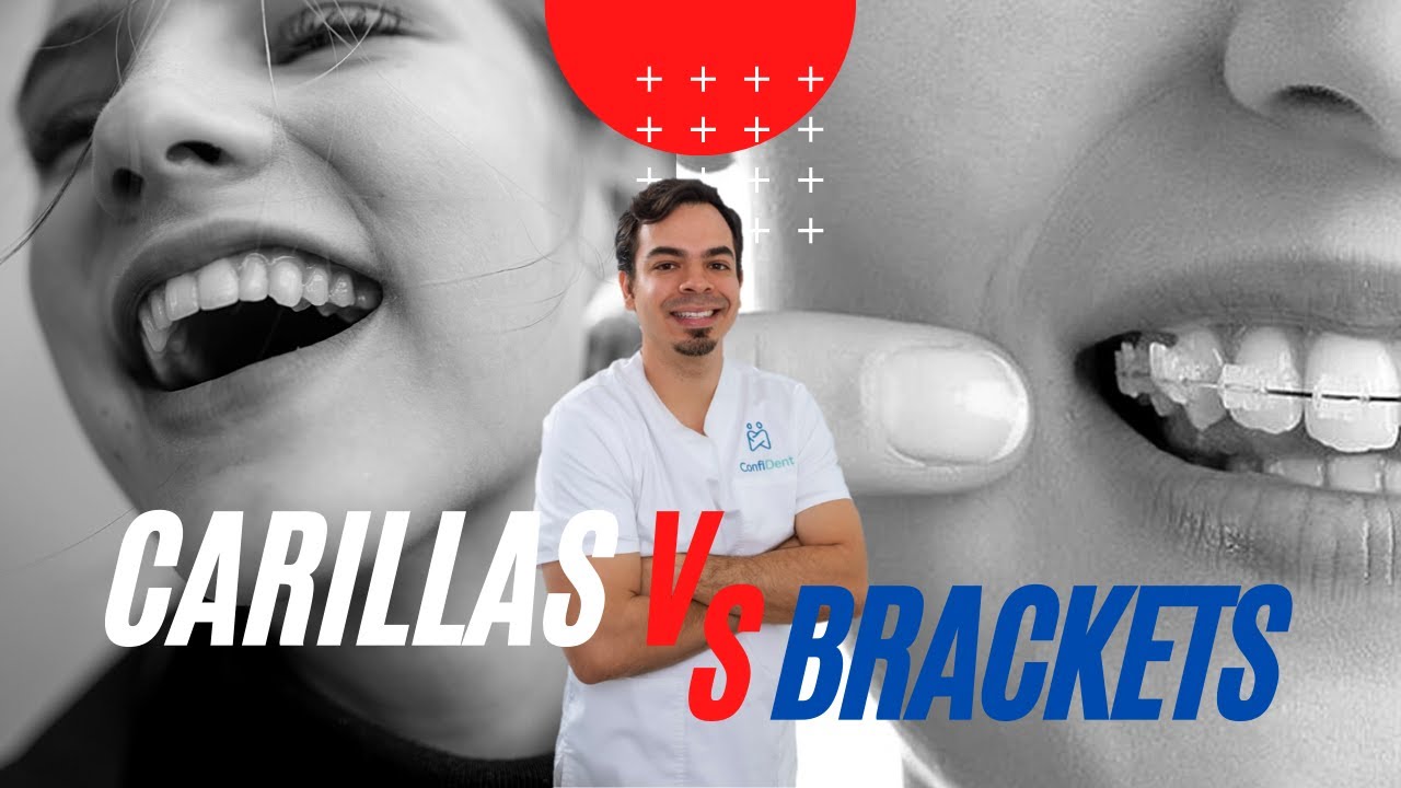 Carillas vs Brackets, ¿que tratamiento es mejor?