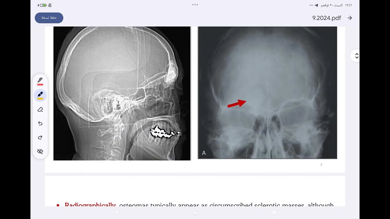 oral pathology lec 9 bone neoplasm. مرحلة رابعة طب اسنان