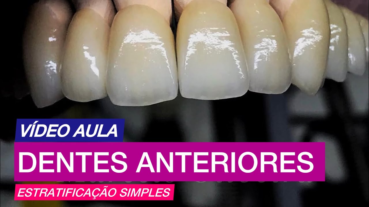 Estratificação simples em dentes anteriores