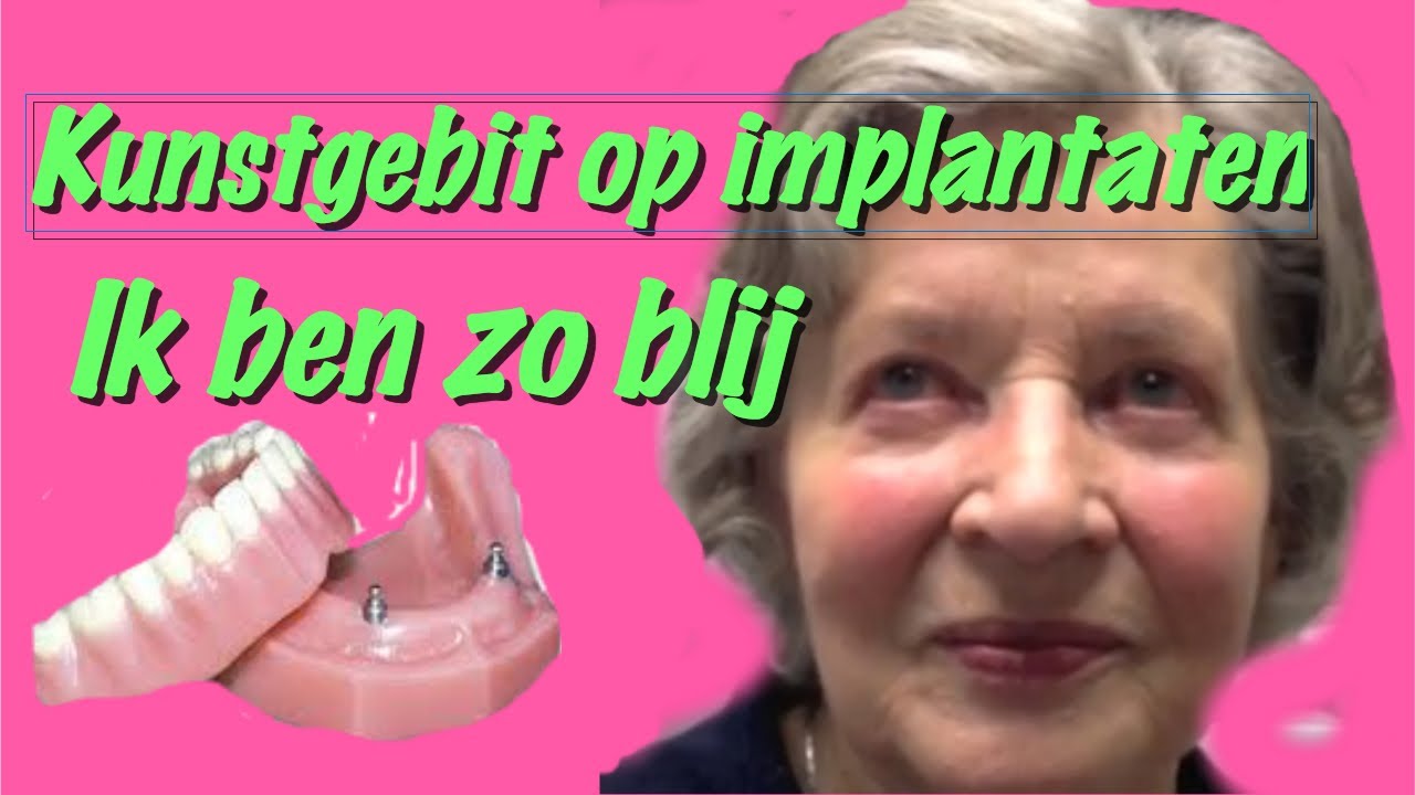 Kunstgebit op implantaten,het klikgebit, gemaakt in Amsterdam Zuidoost.