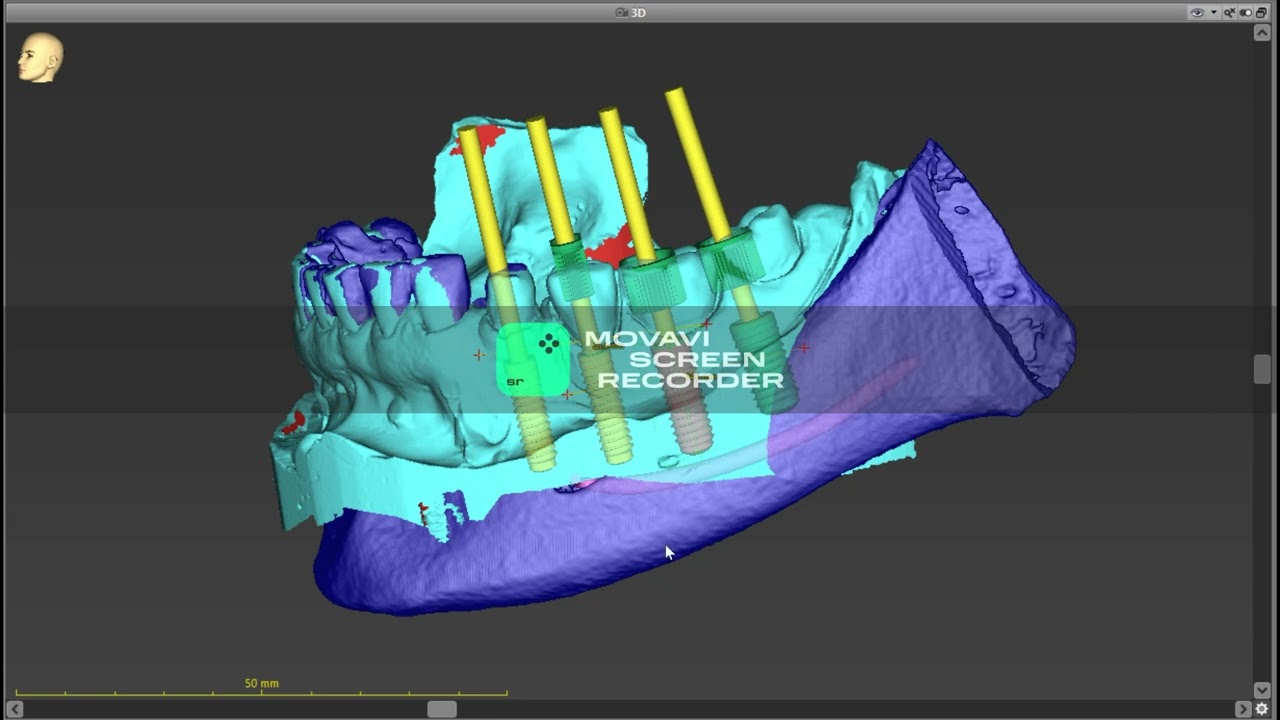 ULTRAMODERN FOGH&Uacute;Z&Aacute;S FOGIMPLANT&Aacute;TUM BE&Uuml;LTET&Eacute;S CSONTP&Oacute;TL&Aacute;S EGYSZERRE #dentist #dentistry #implants