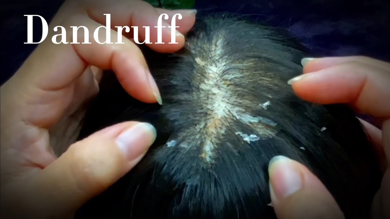 ASMR Super Triggers, Dandruff Removal | No Talking 🥱😴💤