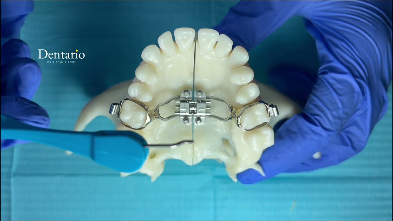 MSE I apparatini qanday burash kerak? | Dentario klinikasi qo&lsquo;llanma