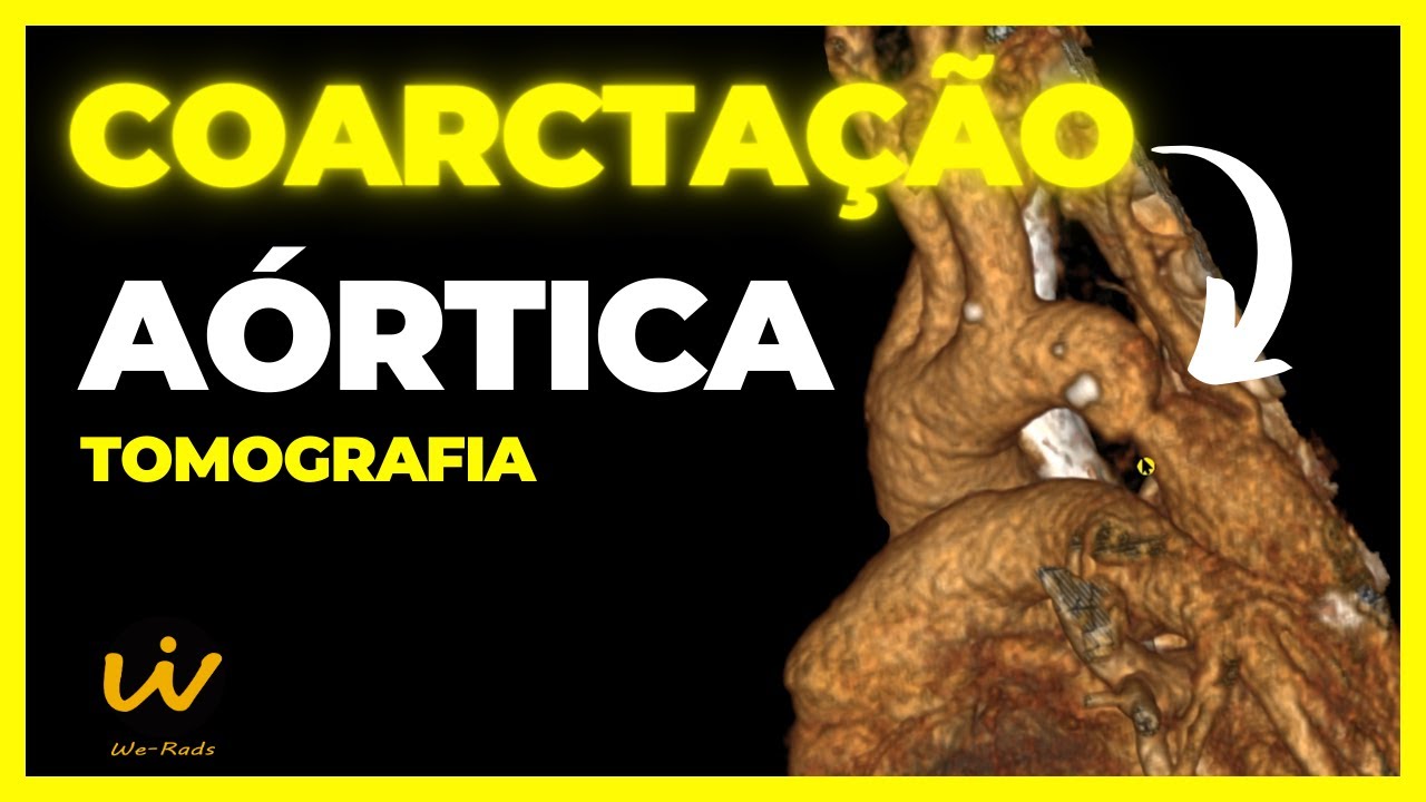 COARCTAÇÃO da AORTA e Persistência da Veia Cava Superior Esquerda
