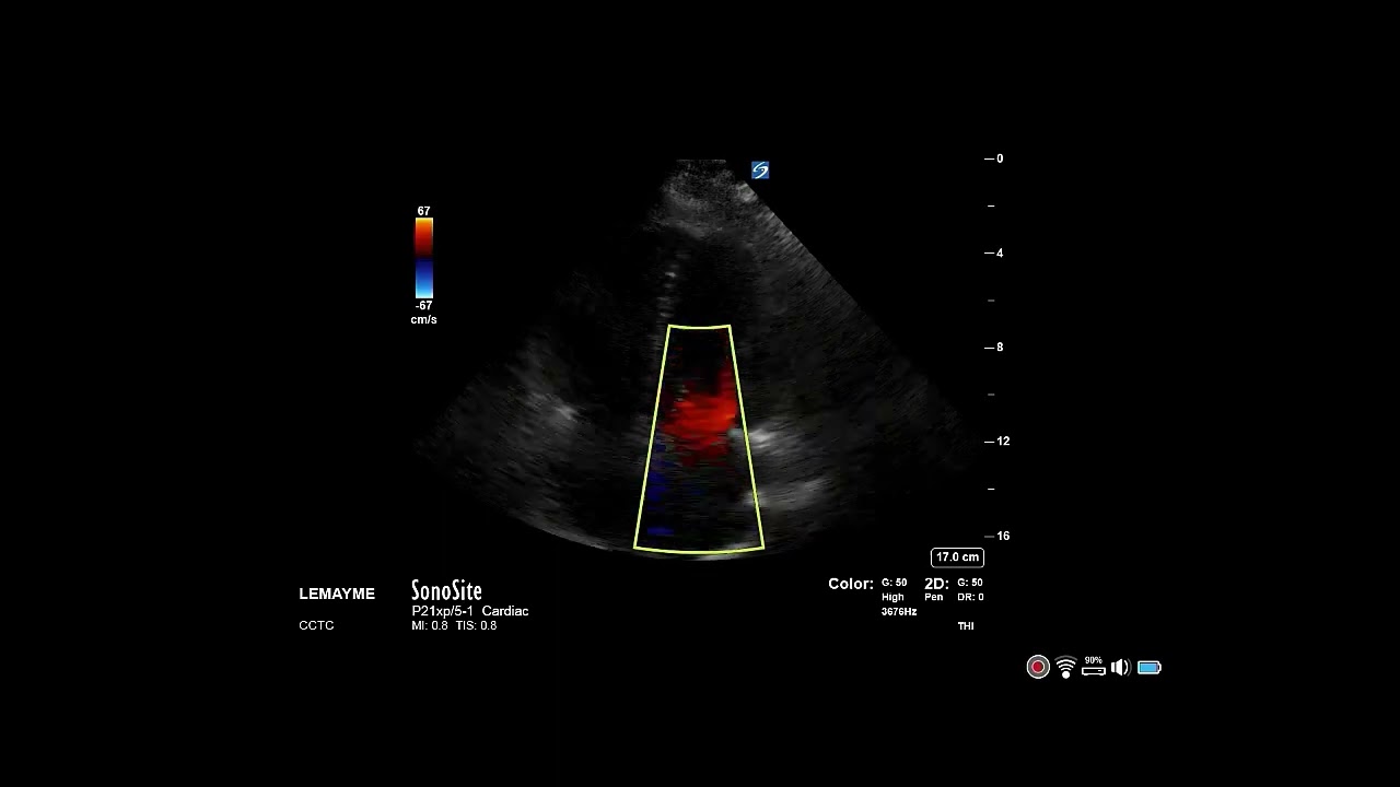 How to...Measure Mitral Stenosis Mean Gradient