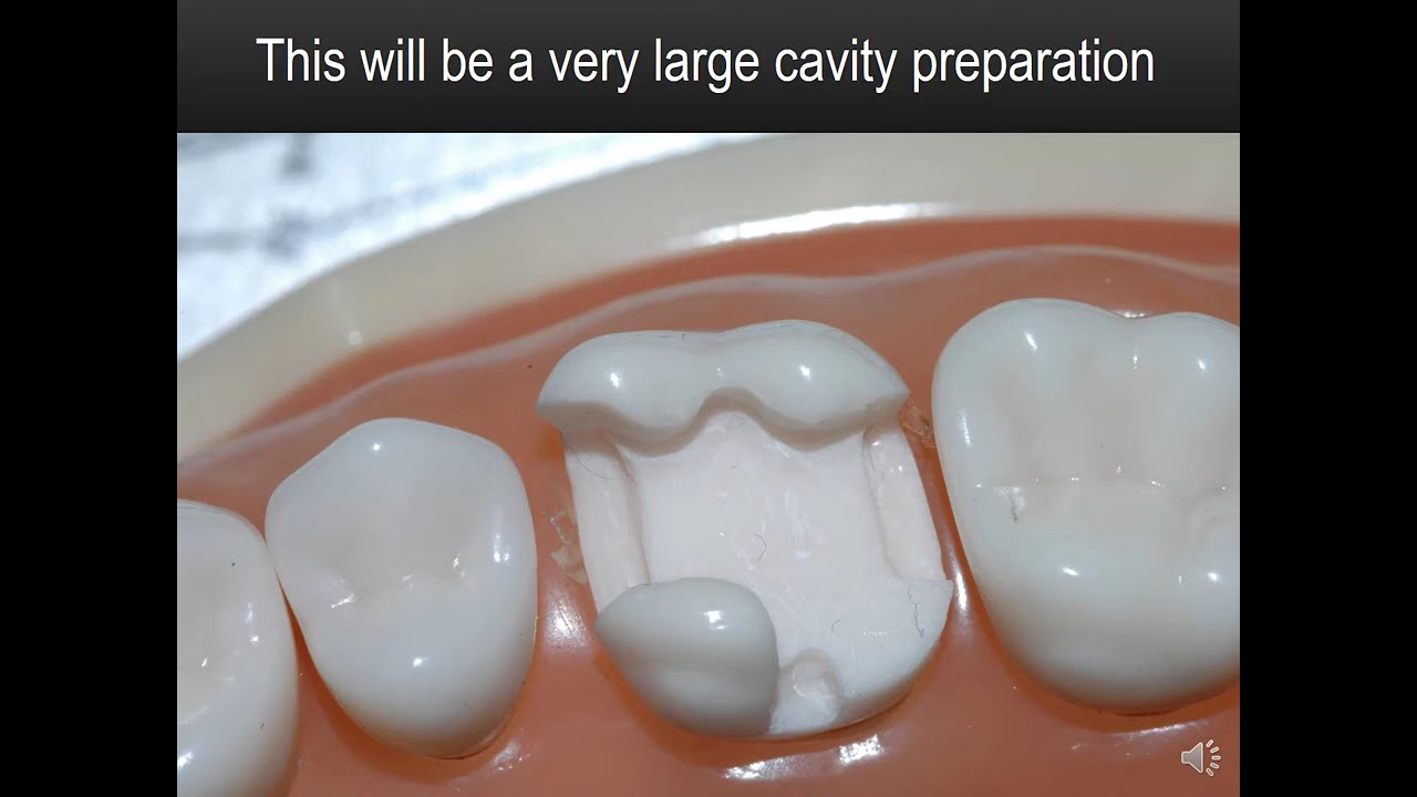 #14 MODL Amalgam Video - Dr. Joel N. Janis