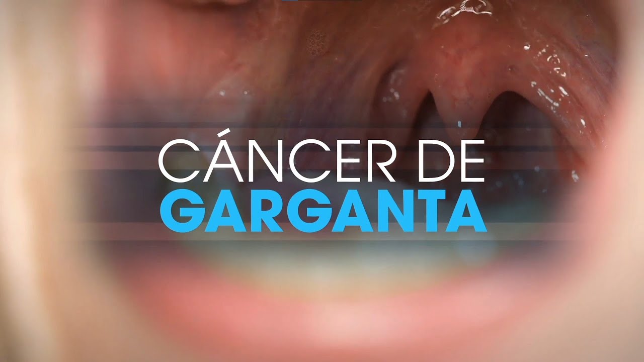 C&aacute;ncer de garganta | Pacientes TV