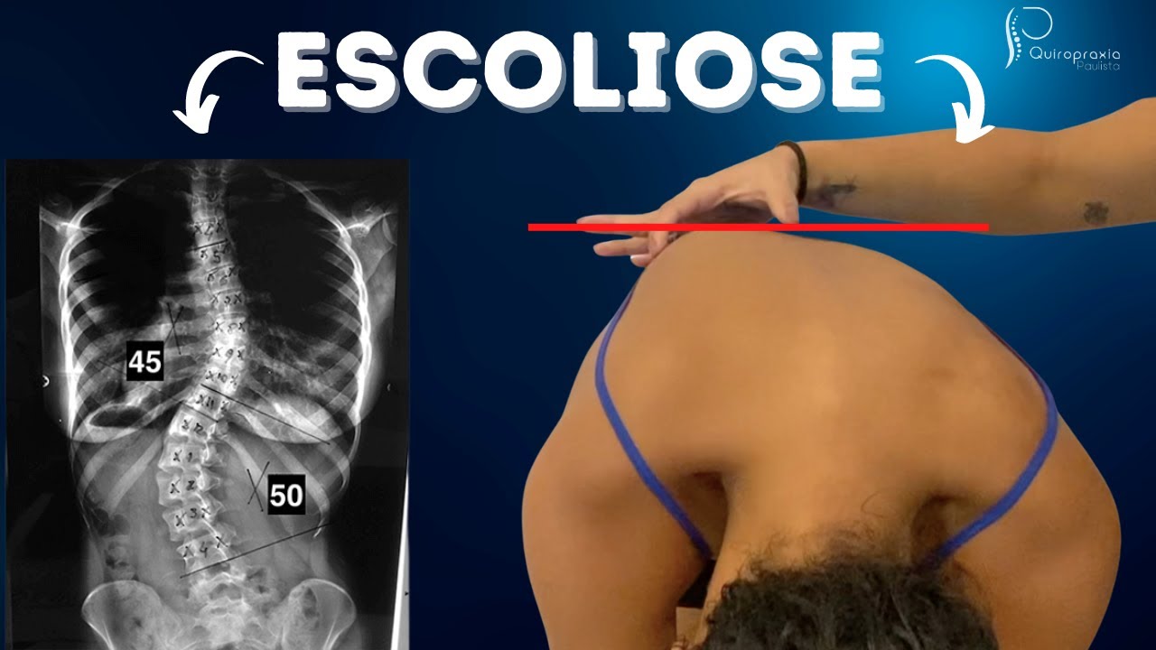 ESCOLIOSE COM QUIROPRAXIA