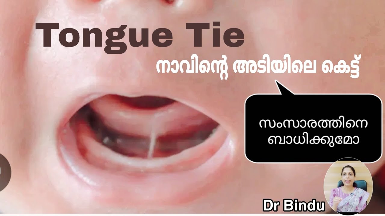 നാക്കിൻ്റെ അടിയിലെ കെട്ട് കൊണ്ടുണ്ടാകുന്ന /Tongue Tie in children/Dr Bindu child health tips