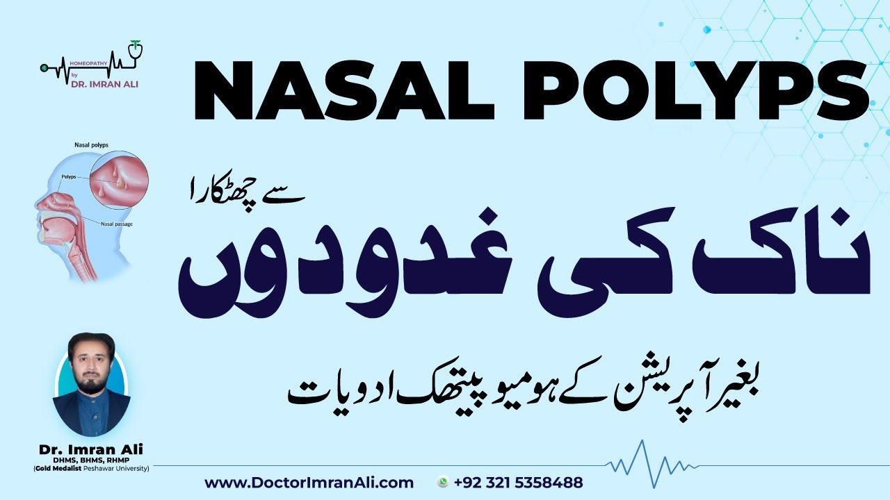Nasal Polyps: How To Cure With Homeopathic Treatment Without Surgery Using Top Grade Medicines