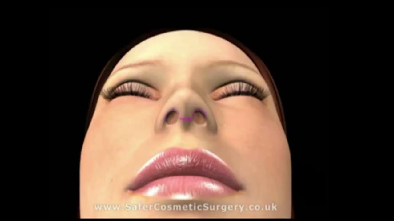 3D simulation of Structural Rhinoplasty