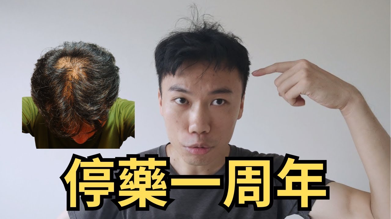 停用藥物一周年，我的頭髮怎麼樣了？你沒聽過的抗禿理論