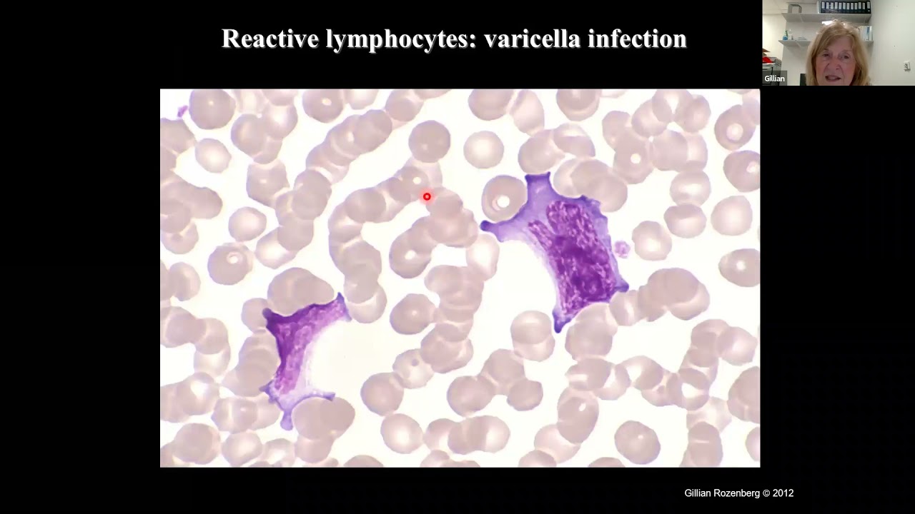 Lymphocytes Reactive vs Neoplastic