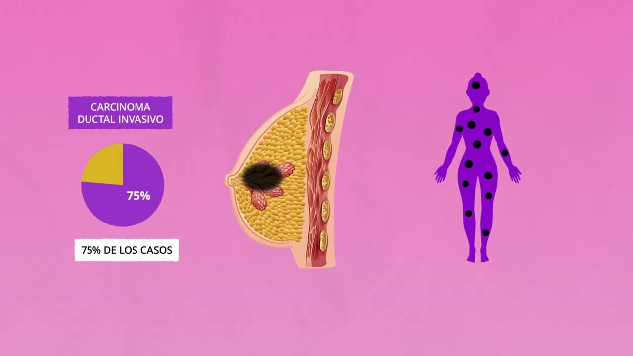 ¿Qué es el cáncer de mama?
