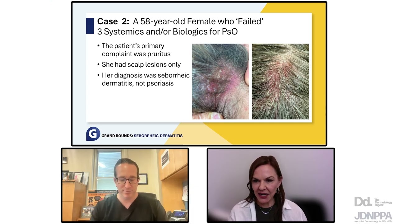 Taking Seborrheic Dermatitis Seriously