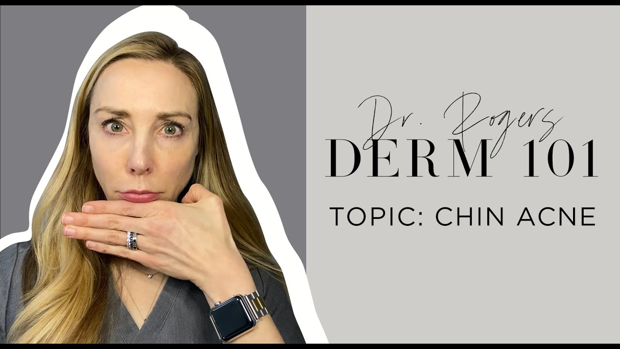 Chin Acne: Causes, Treatment, and Prevention Tips | Dermatologist's Guide