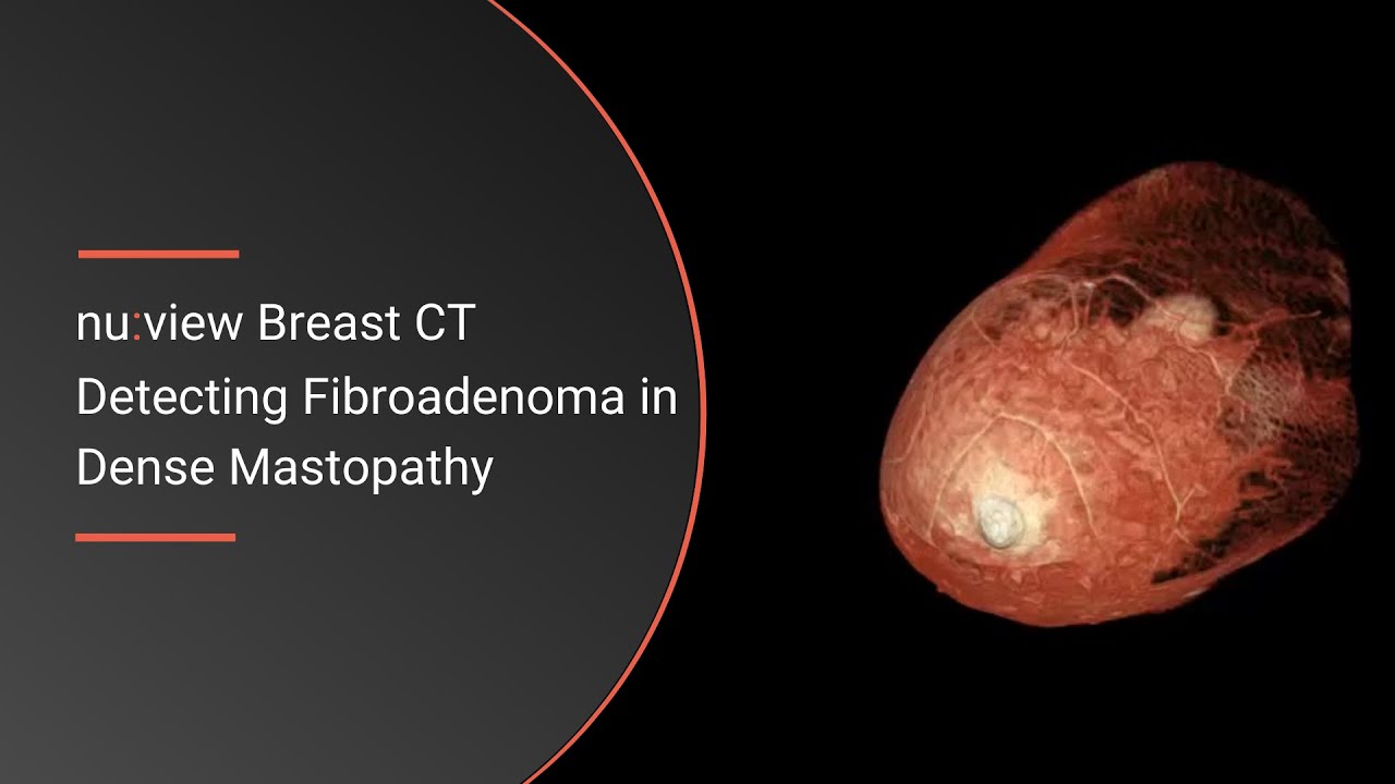 Patient with Dense Mastopahy and Fibroadenoma