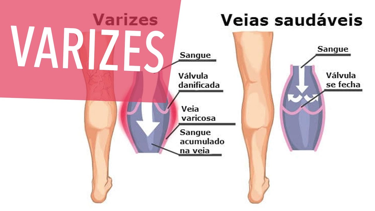 PLANO de SAÚDE cobre TRATAMENTO de VARIZES?