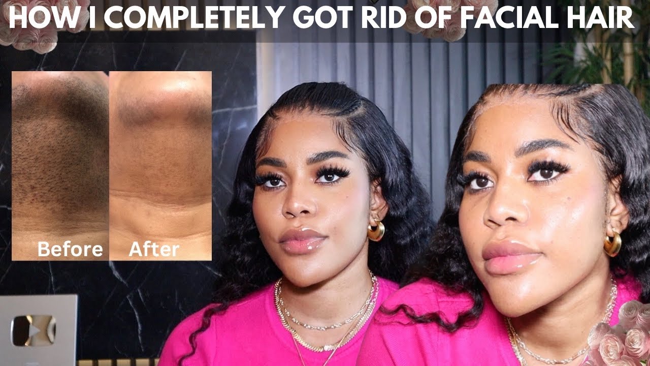HOW TO COMPLETELY GET RID OF FACIAL / CHIN HAIR. My journey with unwanted hair. Ft WESTKISS HAIR