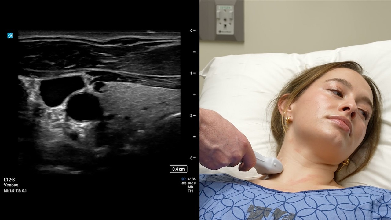 Point-of-Care Ultrasonography of Jugular Venous Pressure