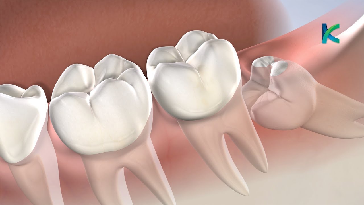 Post-Operative Instructions For Wisdom Teeth Removal in Louisville, KY